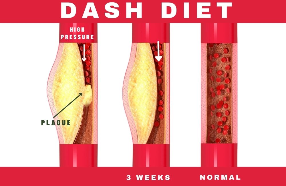 What Is the Dash Diet?