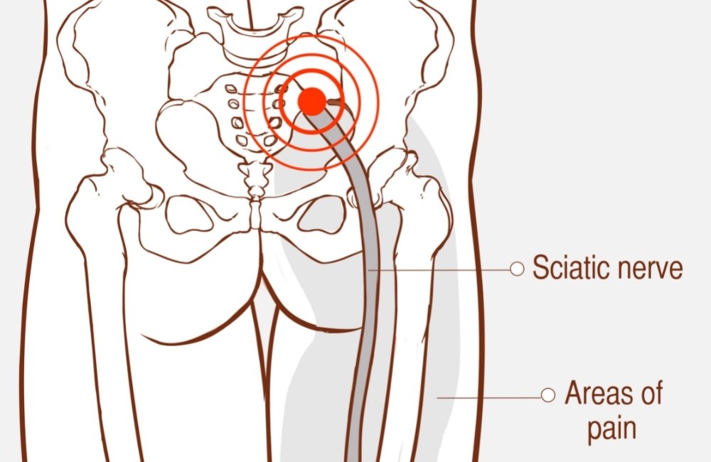 Sciatica Explained