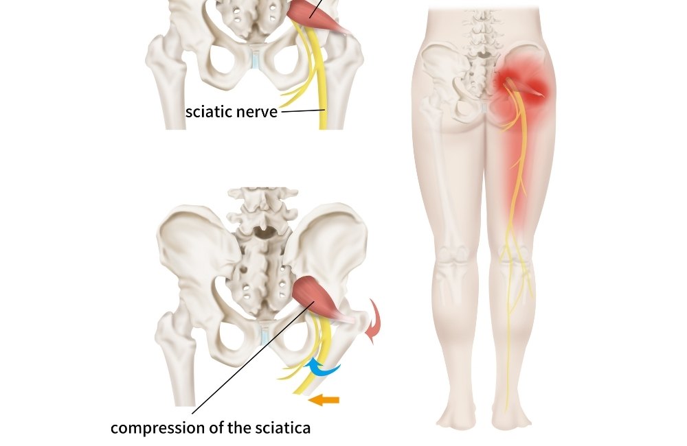 Causes of Sciatica