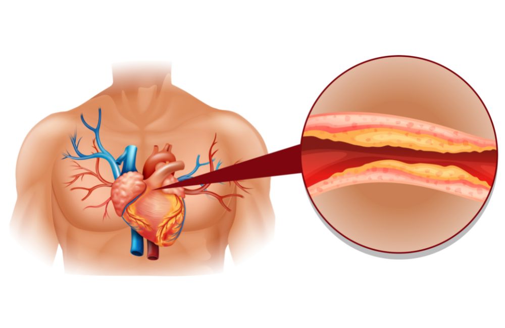 10 foods that can naturally clear clogged arteries and lower bad cholesterol