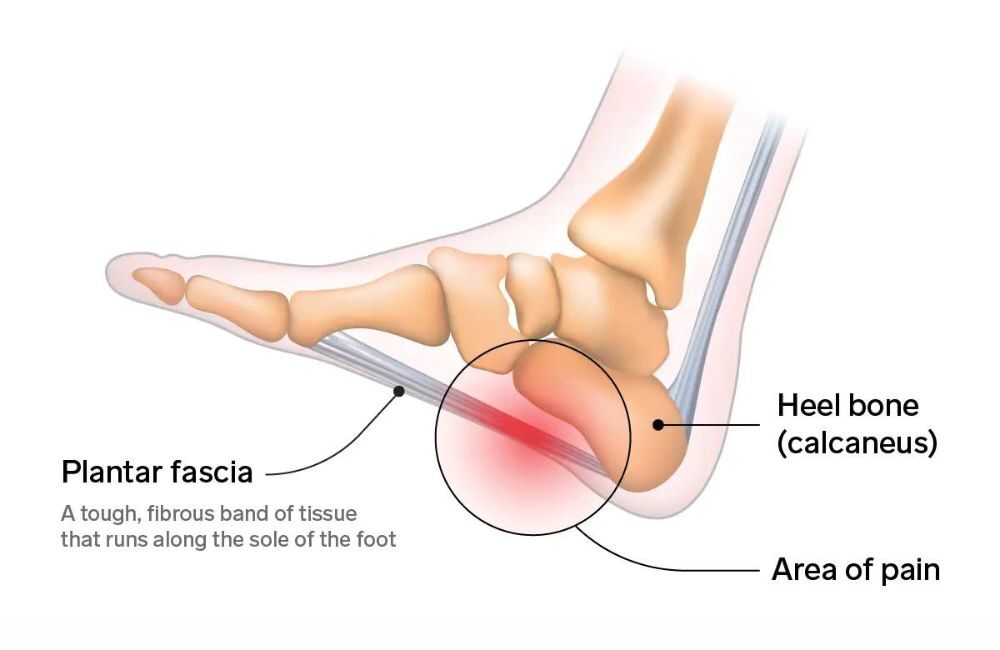 Plantar fasciitis store and shin pain