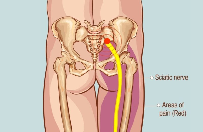 treatment-for-sciatica-medizzy