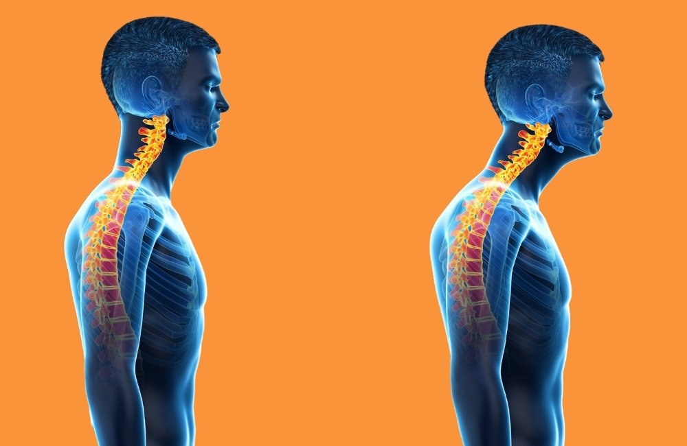 How to fix forward posture
