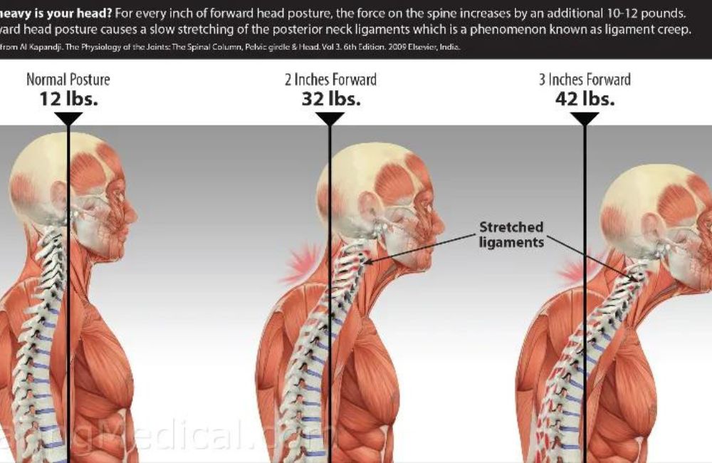 tex neck posture - forward posture