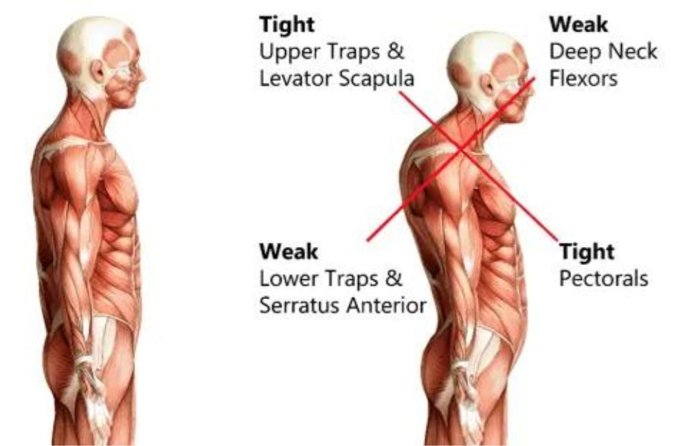 Forward Head Posture and Rounded Shoulders