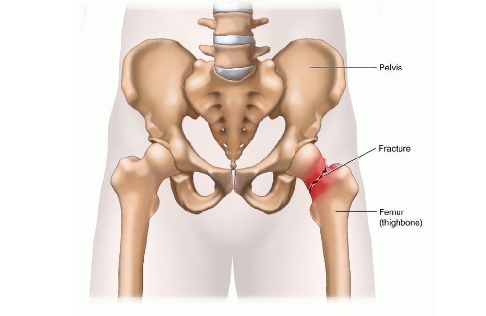 What Is Osteoporosis?