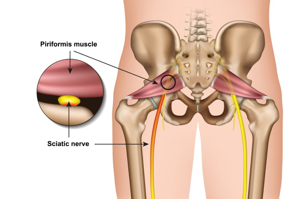 sciatica pain relief exercises