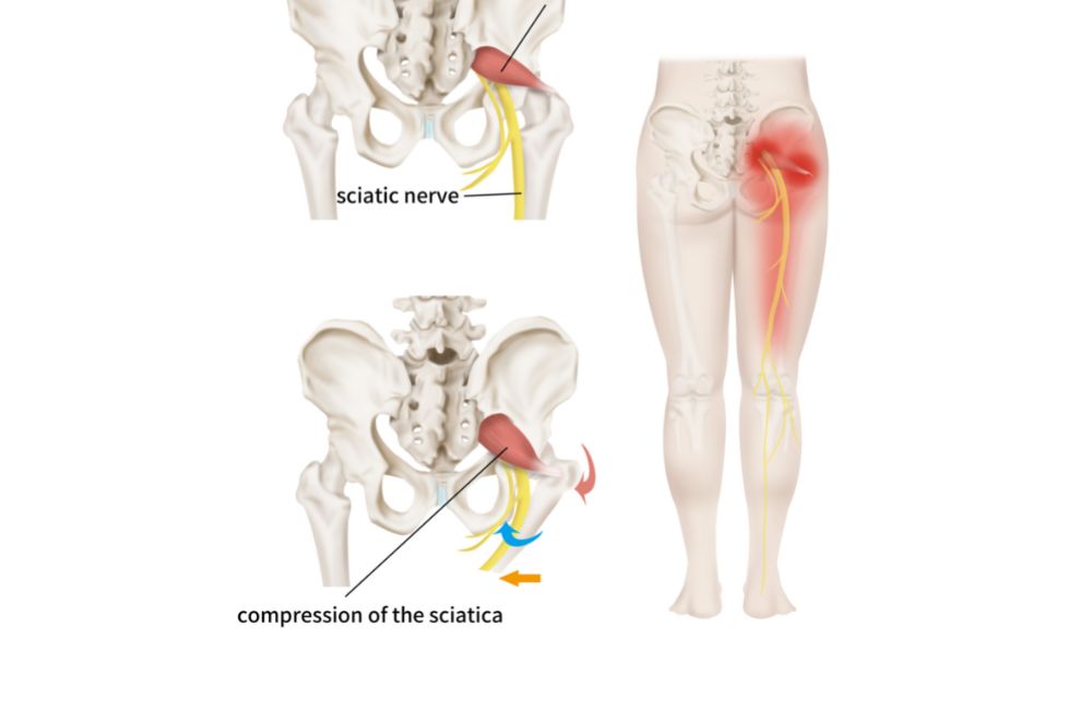 What are the Best Treatments for Sciatica?