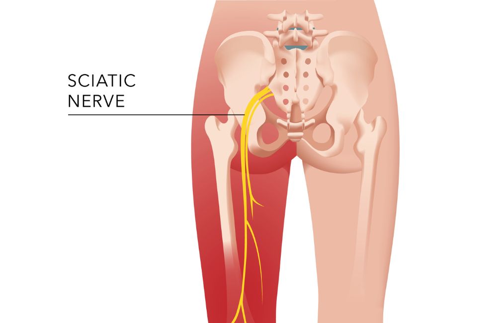 Sciatica Pain Explained