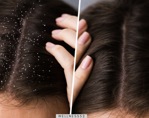 Dandruff shampoos